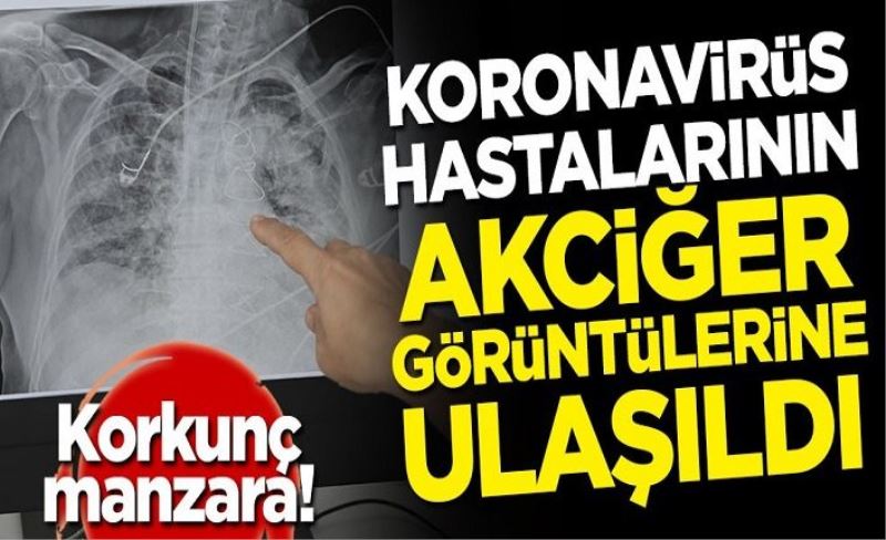 Korkunç! Koronavirüs hastalarının akciğer görüntülerine ulaşıldı